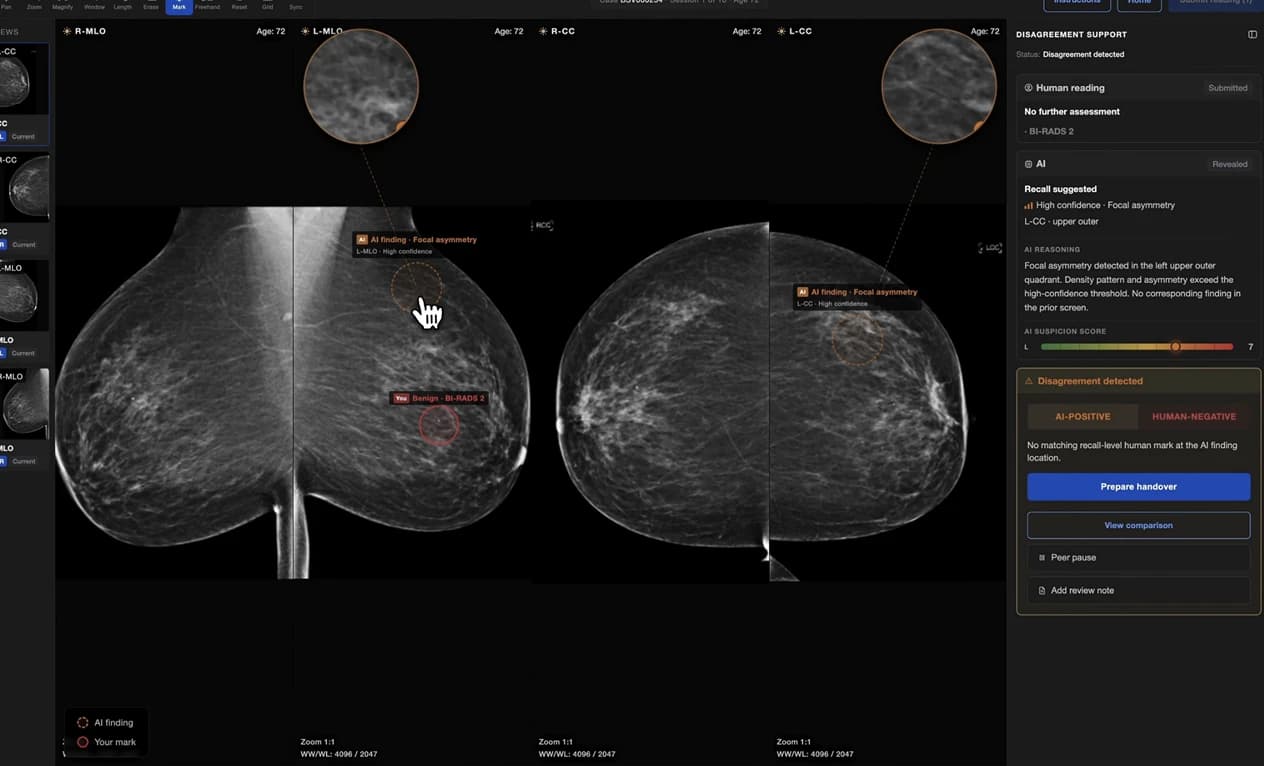 Reading View — mammogram comparison with AI disagreement support panel